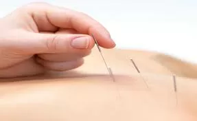 Top 5 lợi ích tuyệt vời của châm cứu đối với sức khỏe của bạn