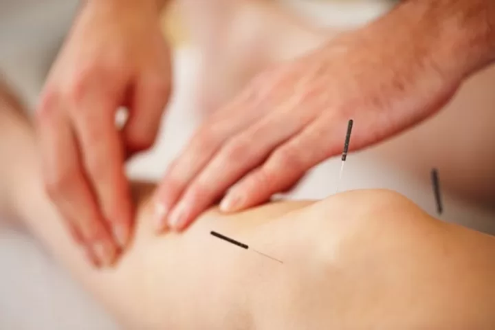 TOP 8 lợi ích của việc châm cứu đối với sức khỏe