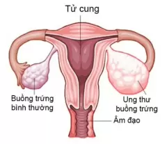 TOP 7 bệnh ung thư nguy hiểm nhất hiện nay