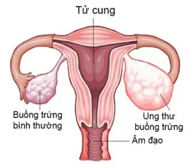 TOP 7 bệnh ung thư nguy hiểm nhất hiện nay