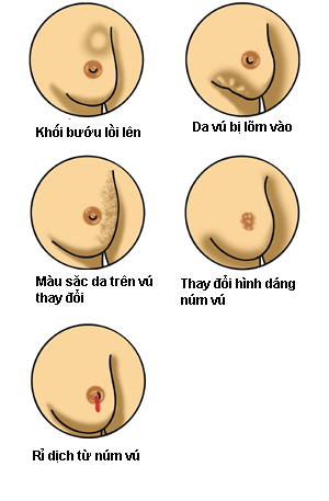 Top 5 thể ung thư gây tử vong hàng đầu ở nữ giới