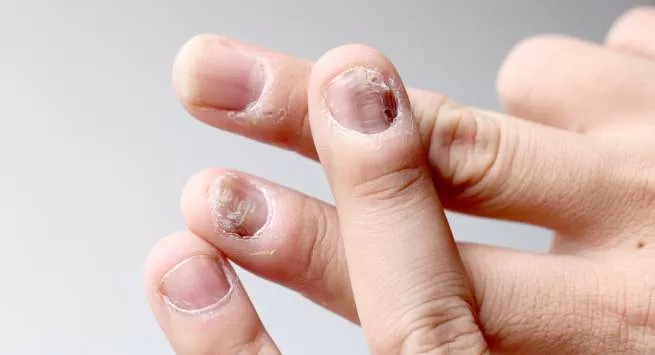 Top 5 tác hại khủng khiếp của thói quen cắn móng tay