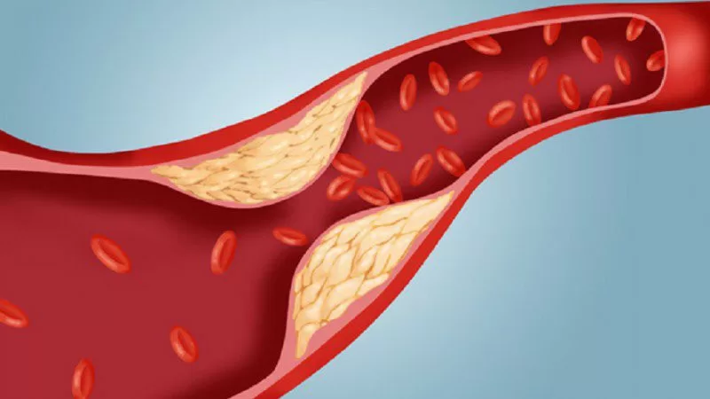 Top 6 dấu hiệu giúp nhận biết sớm được gan nhiễm mỡ để tránh bị viêm gan và sơ gan