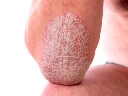 Top 6 bệnh ngoài da bạn hay mắc phải vào mùa hè nắng nóng